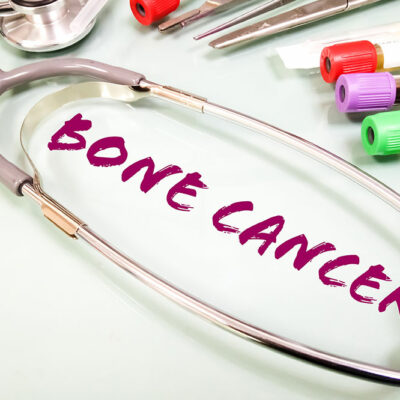 7 warning signs of bone cancer to be aware of