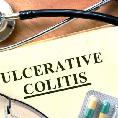 10 early signs of ulcerative colitis to not ignore